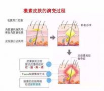 缔美诗皮肤管理：激素性皮炎小课堂一