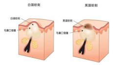 缔美诗皮肤管理：治好多年的痘痘要多少钱？三千够吗？